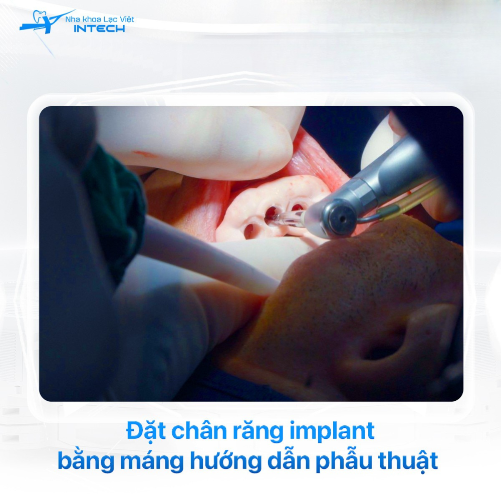 Bác sĩ ứng dụng máng hướng dẫn phẫu thuật Guideline để tăng độ chính xác khi đặt trụ Implant