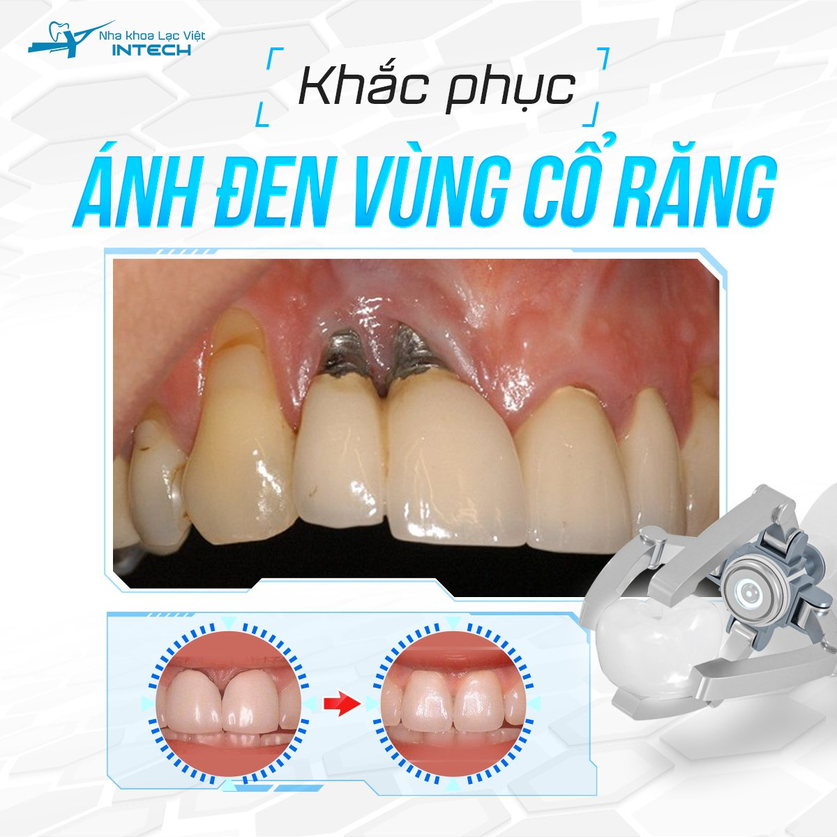 Giải pháp DCT cải thiện tình trạng ánh đen cổ răng mà các phương pháp truyền thống chưa làm được