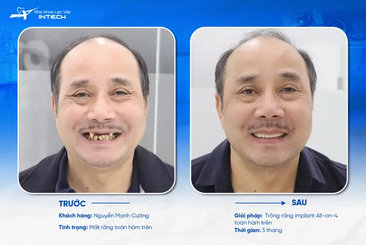 Cấy ghép Implant thẩm mỹ có đáng tin cậy không?
