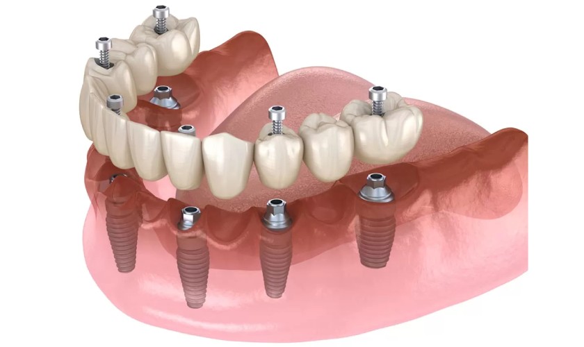 Trồng răng implant toàn hàm