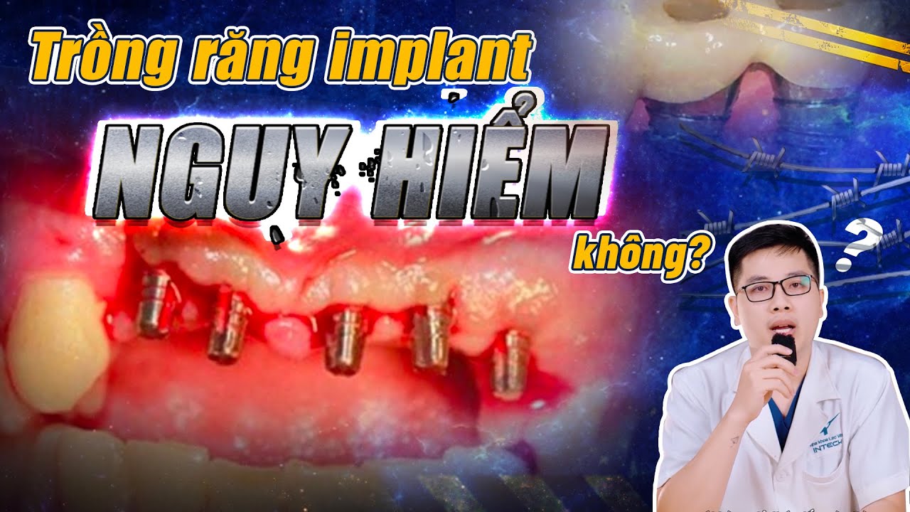 Cấy Implant có nguy hiểm không? Bác sĩ implant nào nên lựa chọn để an toàn tuyệt đối?