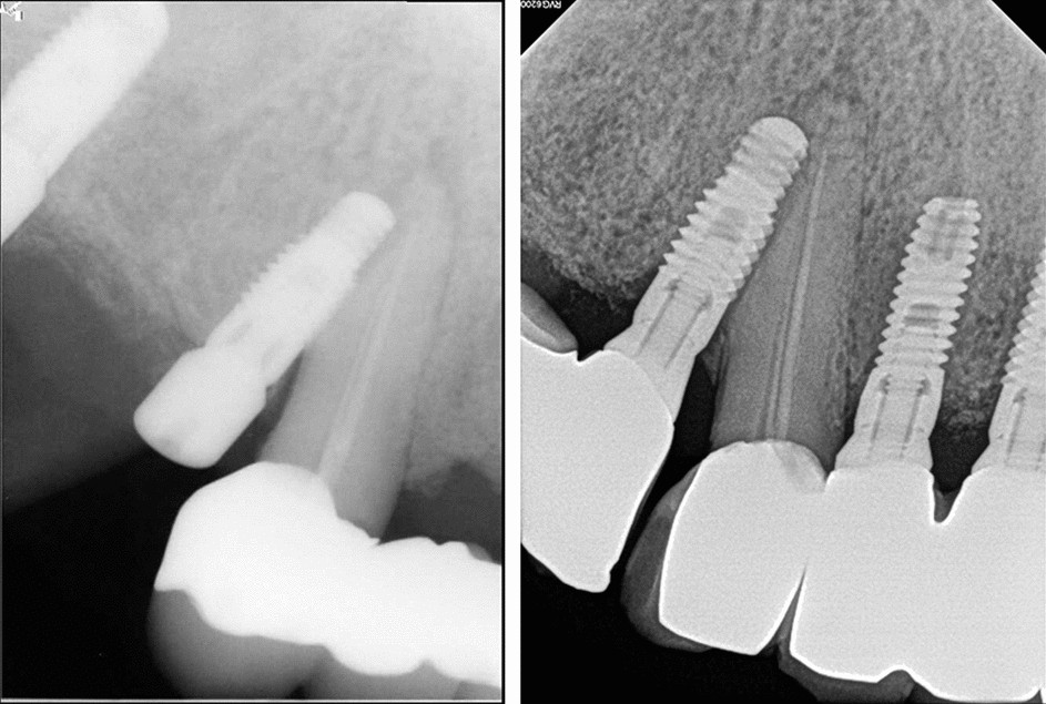 Trên phim X-quang cho thấy vị trí cấy implant ảnh hưởng đến răng bên cạnh do đặt lệch vị trí.
