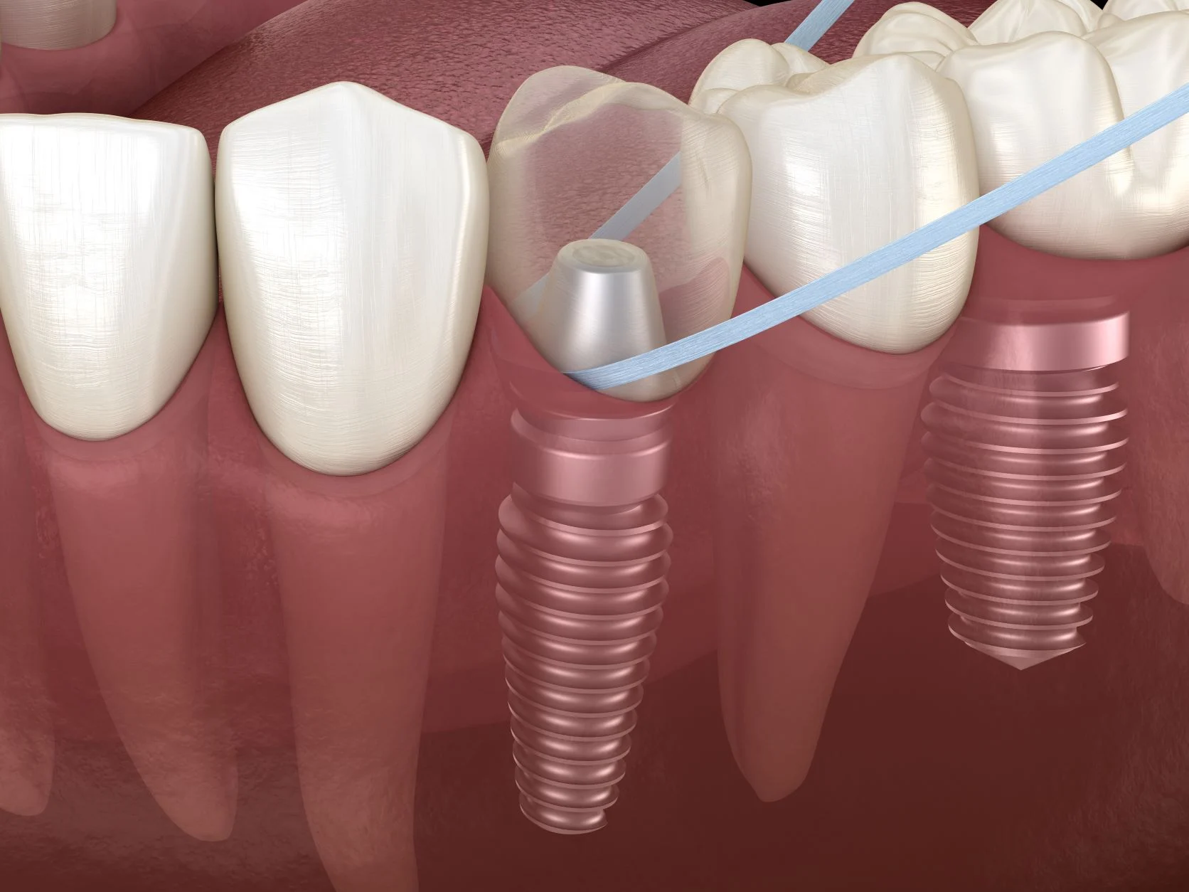 Chăm sóc răng implant