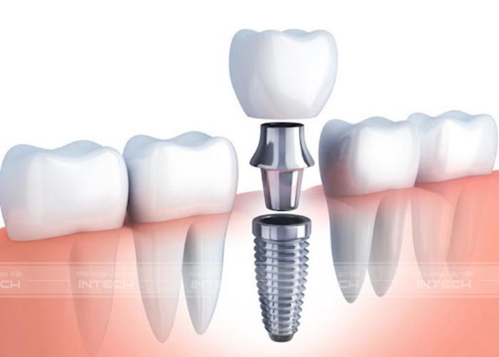 Chất liệu răng implant tại Nha khoa Lạc Việt Intech đều có xuất xứ rõ ràng, thương hiệu nổi tiếng