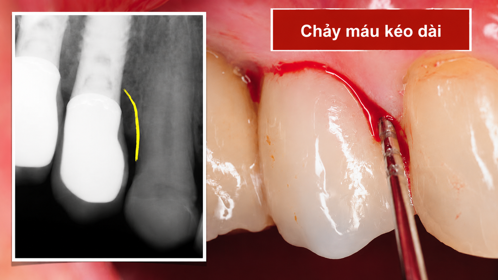 Hối hận khi trồng implant do chảy máu kéo dài 