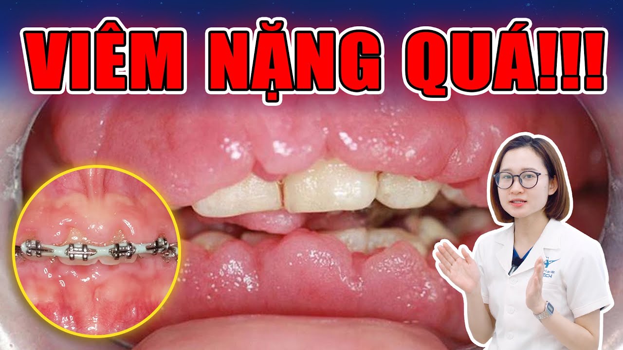 Viêm lợi trùm khi niềng răng: Nguyên nhân và cách xử lý hiệu quả