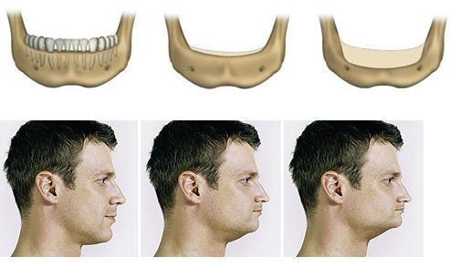 Sơ đồ mô tả xương hàm bị tiêu sau khi mất răng lâu năm.