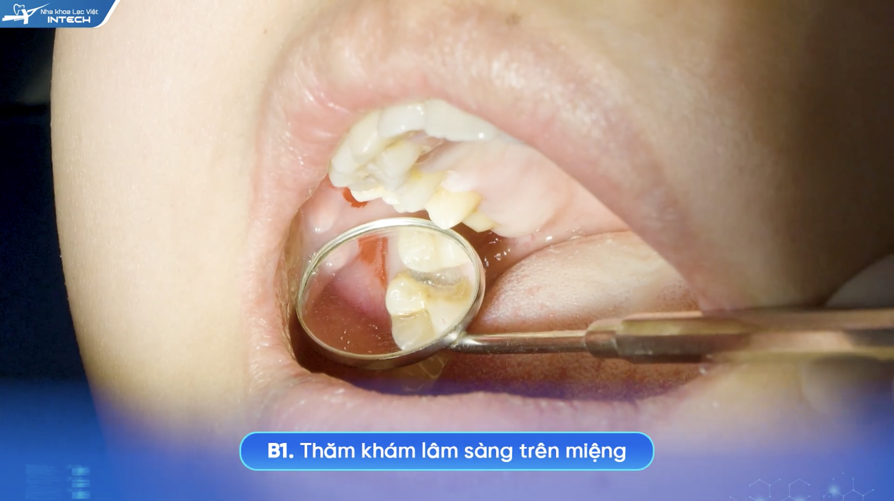 Bác sĩ sẽ thăm khám lâm sàng trước khi điều trị tuỷ răng