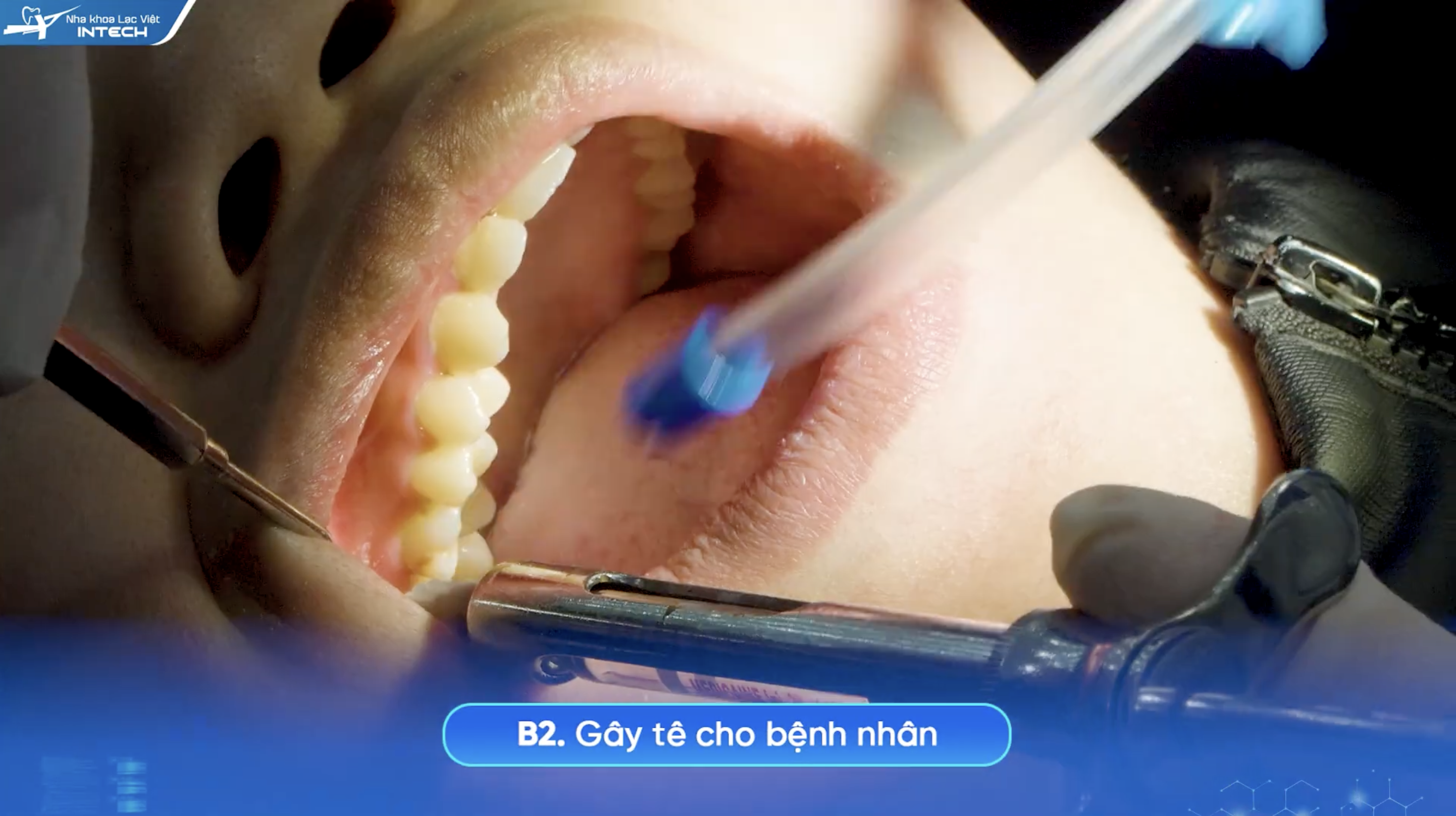 Gây tê cục bộ cho bệnh nhân để loại bỏ cảm giác đau
