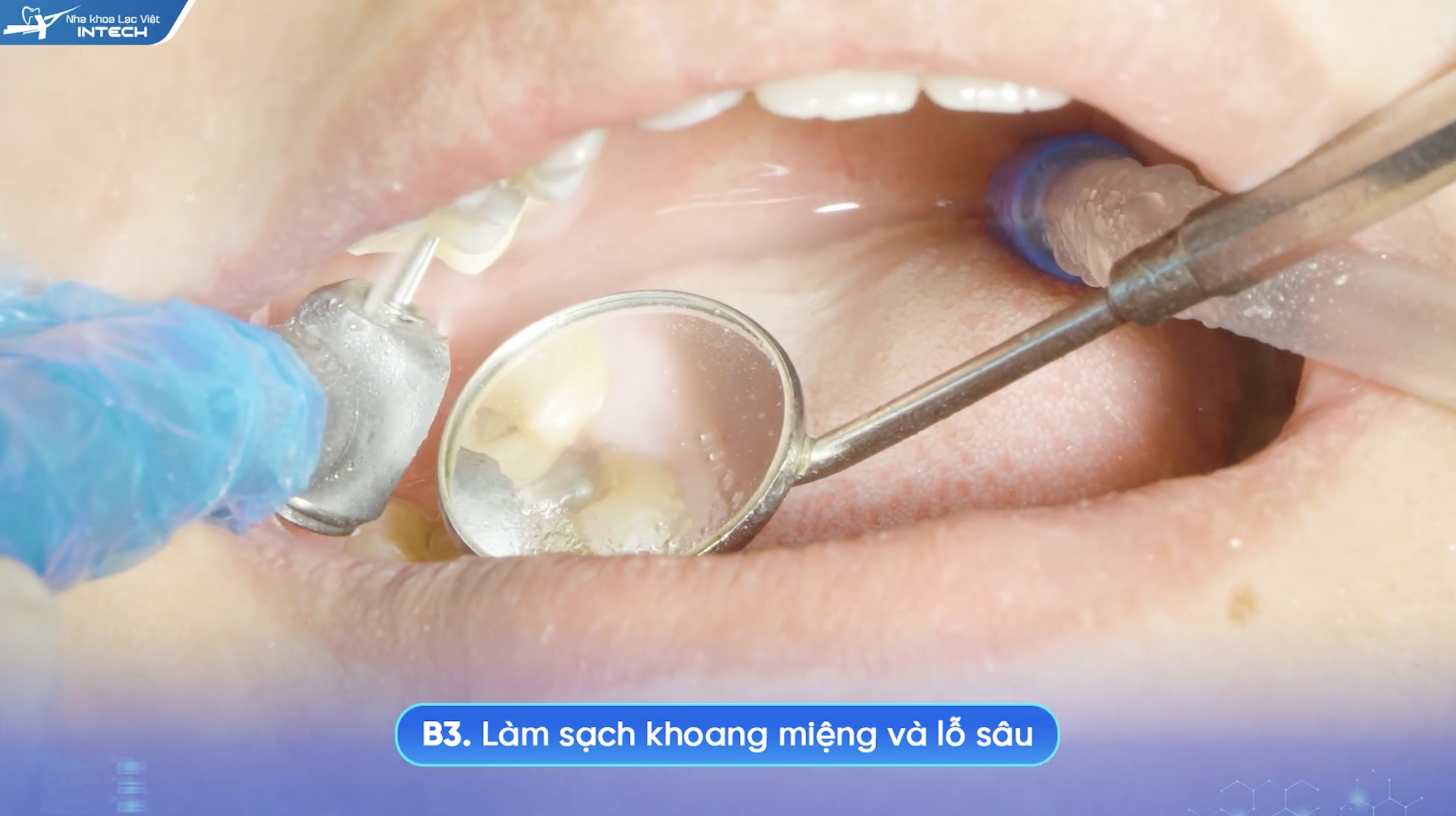 Làm sạch khoang miệng và mở tuỷ
