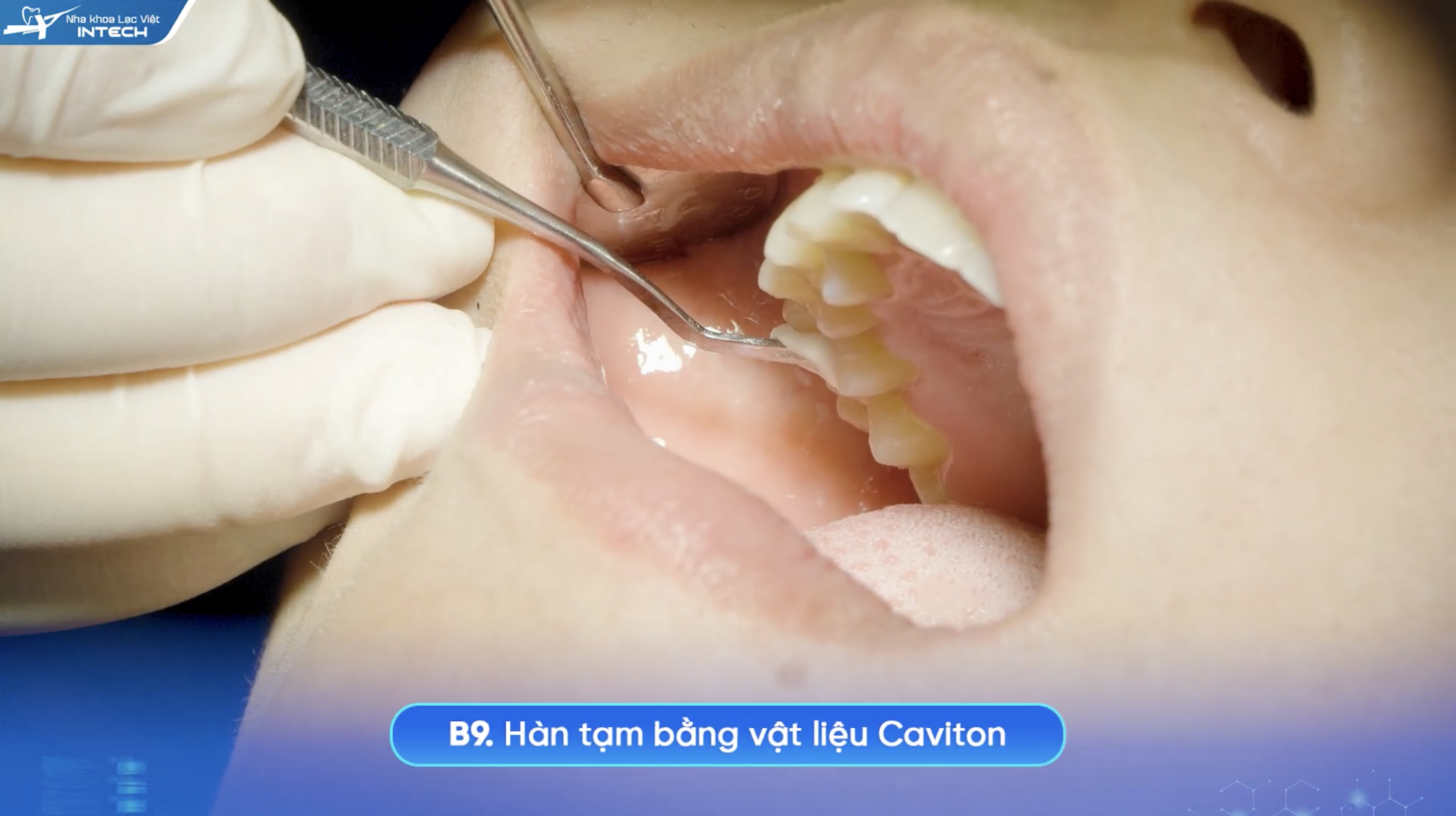 Hàn bằng vật liệu chuyên dụng