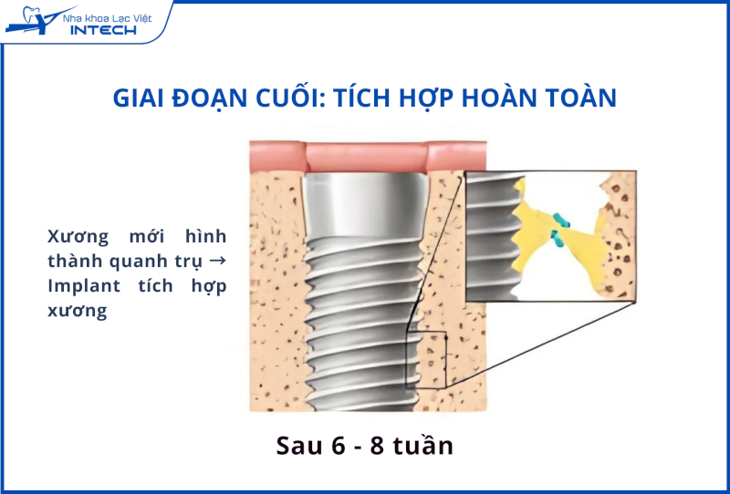Cận cảnh cấu trúc trụ Implant Titanium tích hợp vào xương hàm