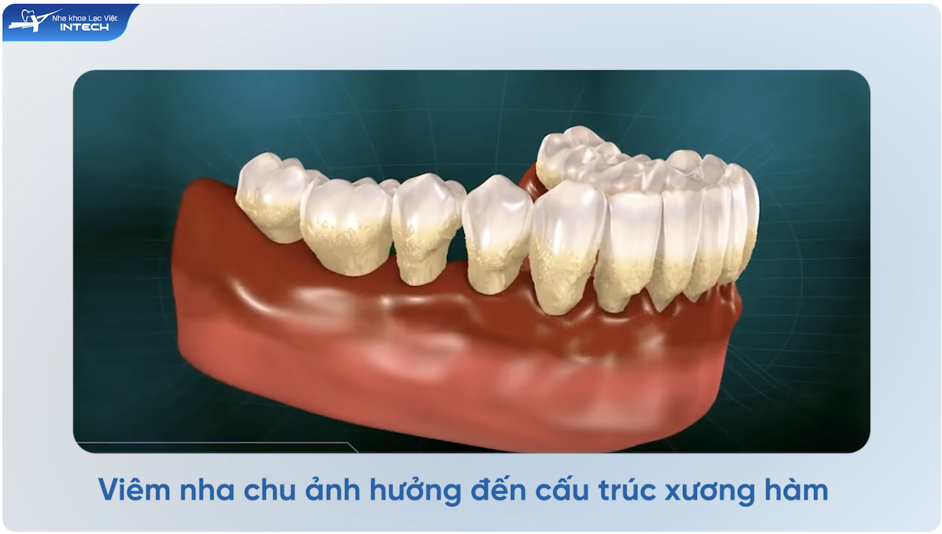 viêm lợi dẫn đến viêm nha chu