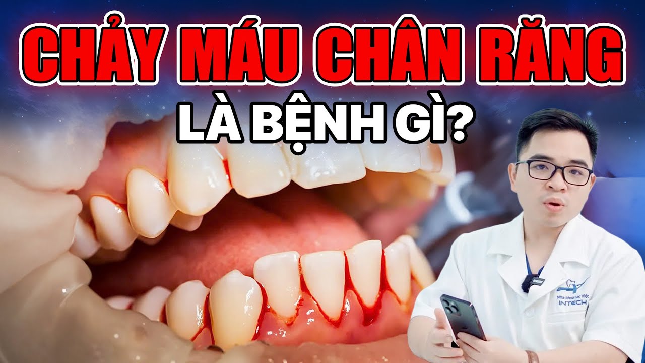 Chảy máu chân răng: Nguyên nhân và giải pháp điều trị dứt điểm từ chuyên gia
