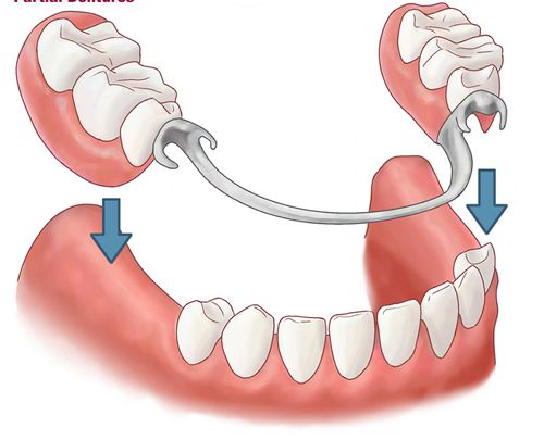 Hàm giả tháo lắp sử dụng móc kim loại để bám vào răng thật