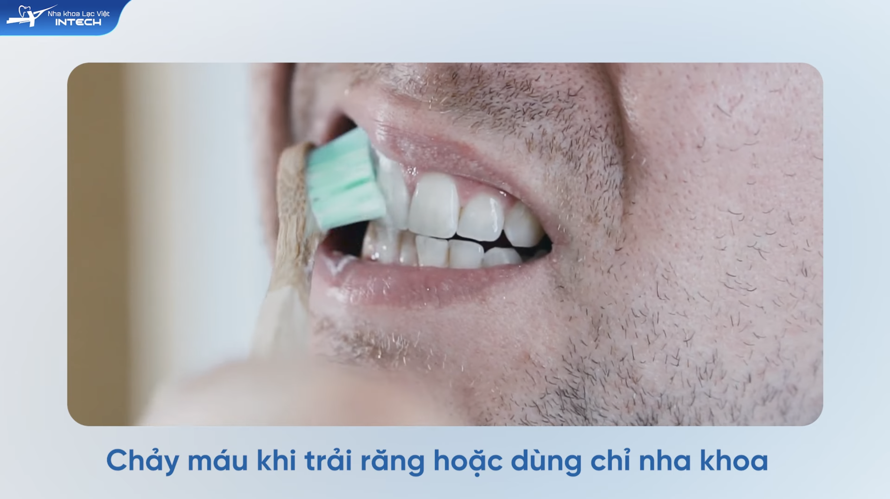 Khi chải răng hoặc dùng chỉ nha khoa bị chảy máu thì có thể là chảy máu nướu răng do viêm nha chu