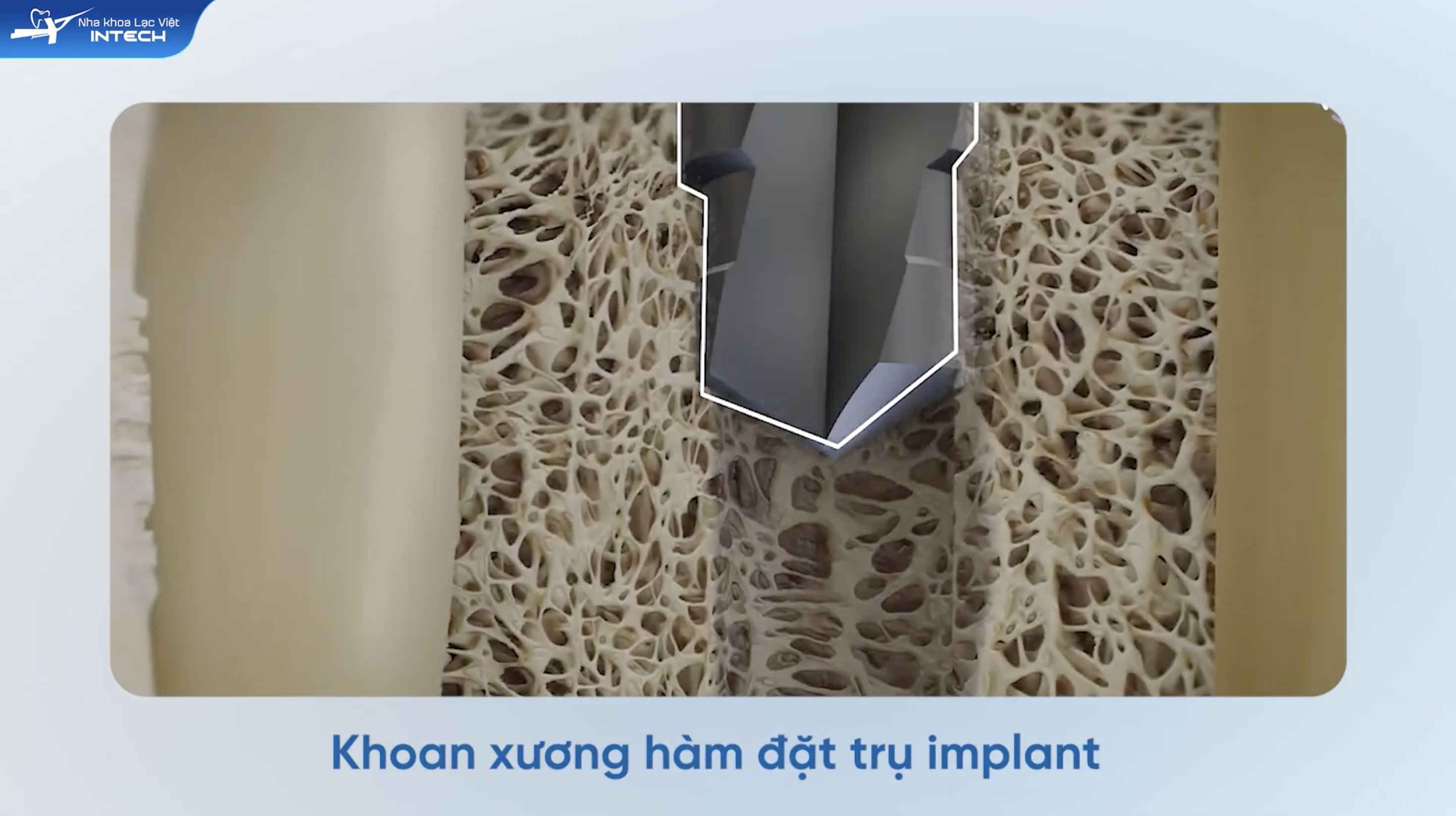 Thực chất cơn đau không đến từ việc khoan vào xương hàm mà do quá trình sưng viêm hậu phẫu