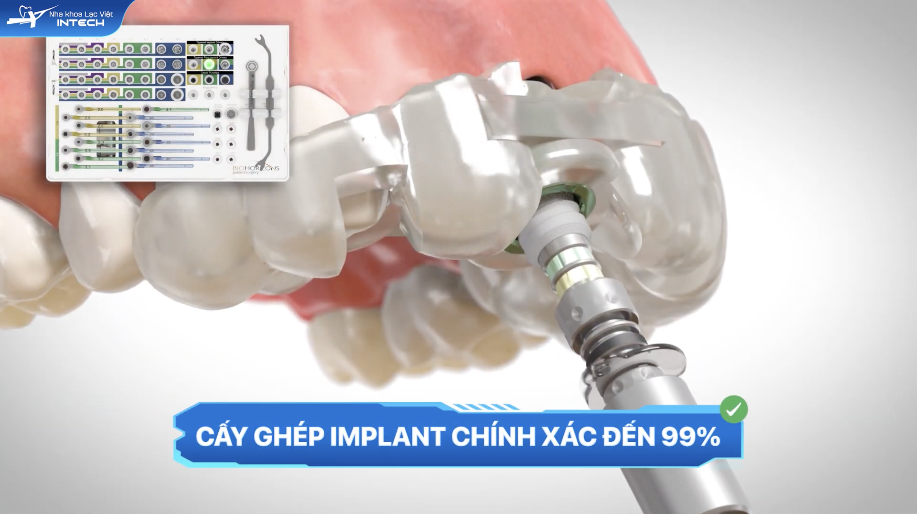 Máng hướng dẫn phẫu thuật giúp đặt trụ chính xác gần như 99% giúp ca cấy ghép nhanh chóng và hạn chế tối đa cơn đau
