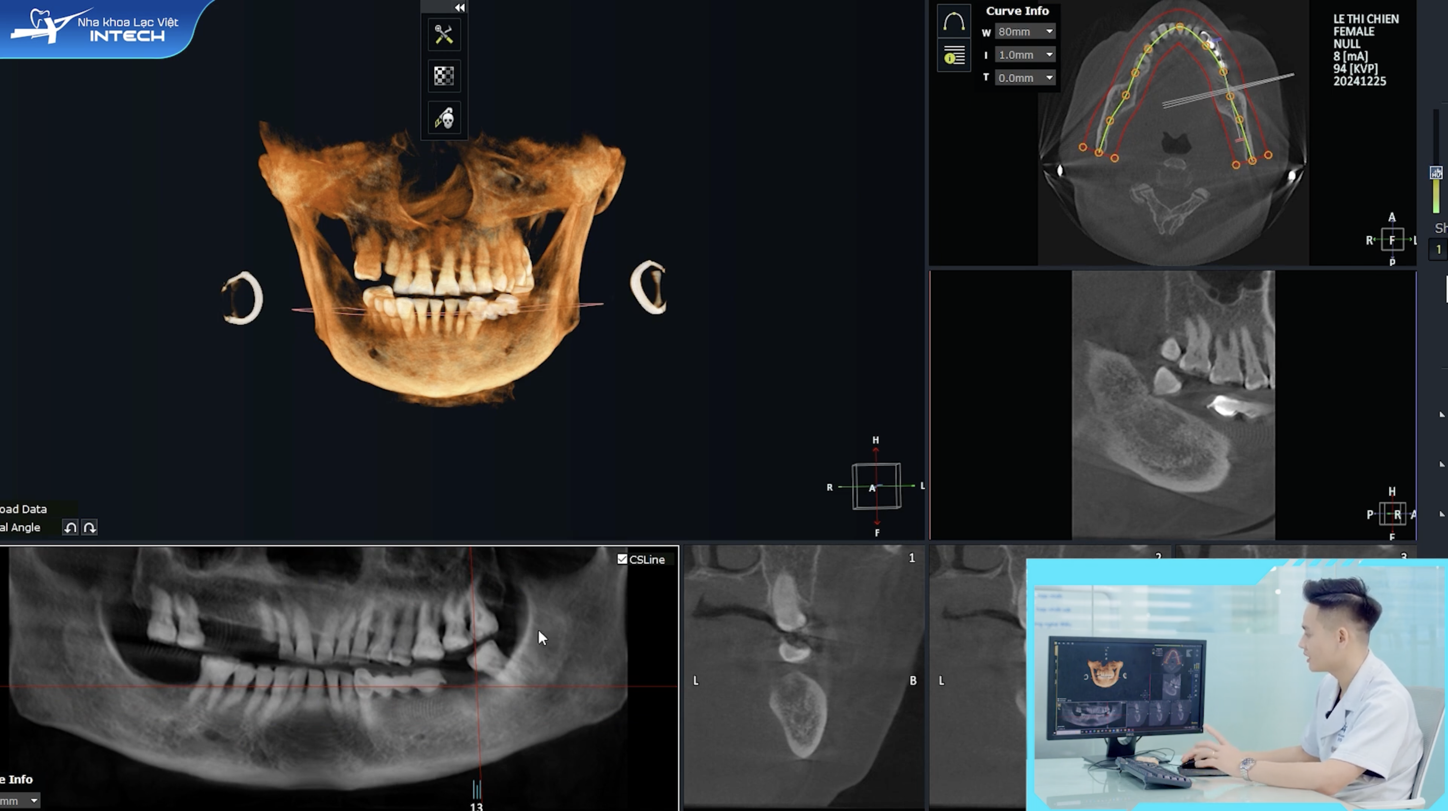 Phim chụp CT Cone Beam 3D giúp các bác sĩ xác định chính xác các cấu trúc giải phẫu quan trọng