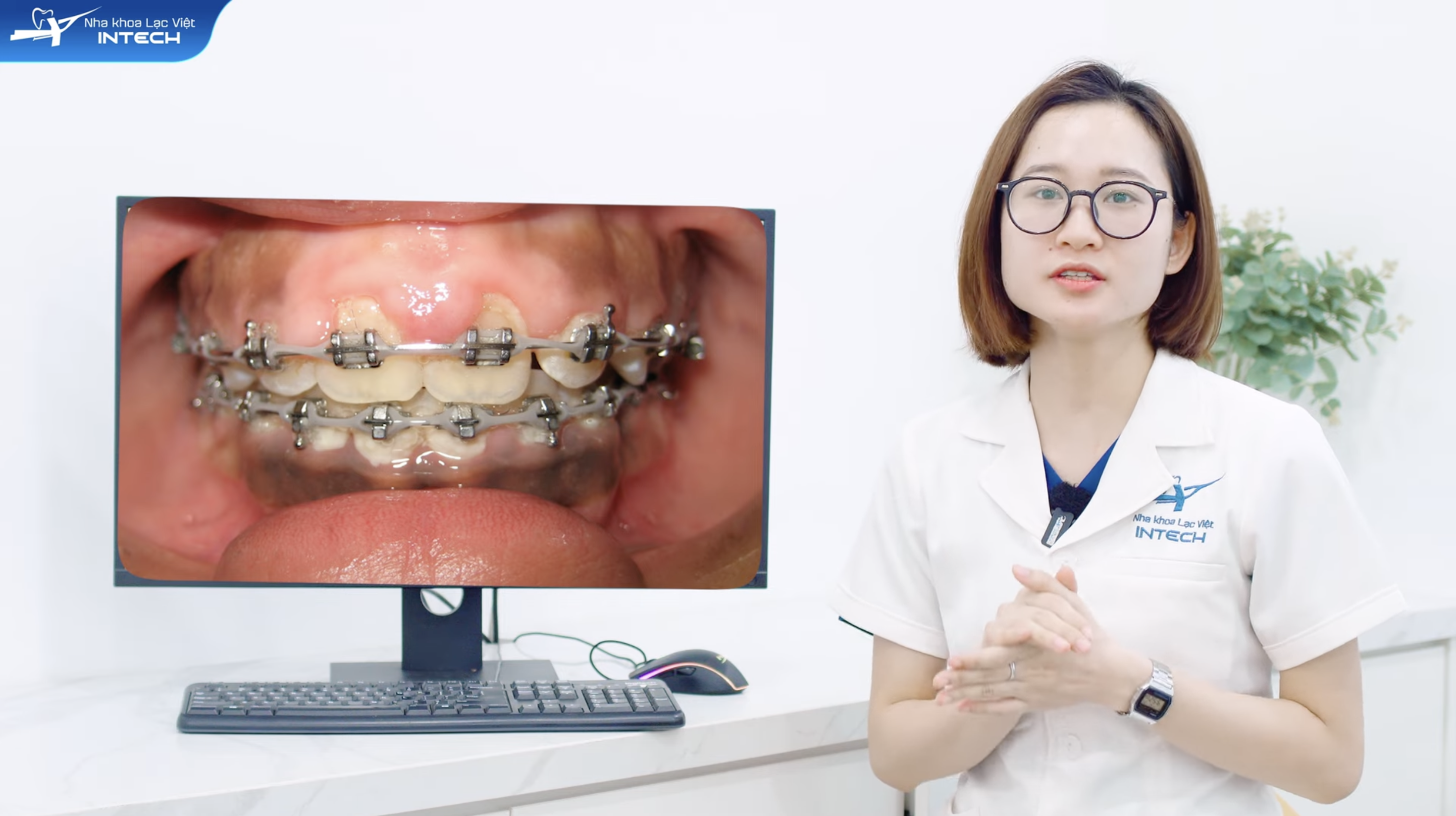 Viêm lợi khi niềng răng có thể ảnh hưởng đến hiệu quả của việc niềng răng