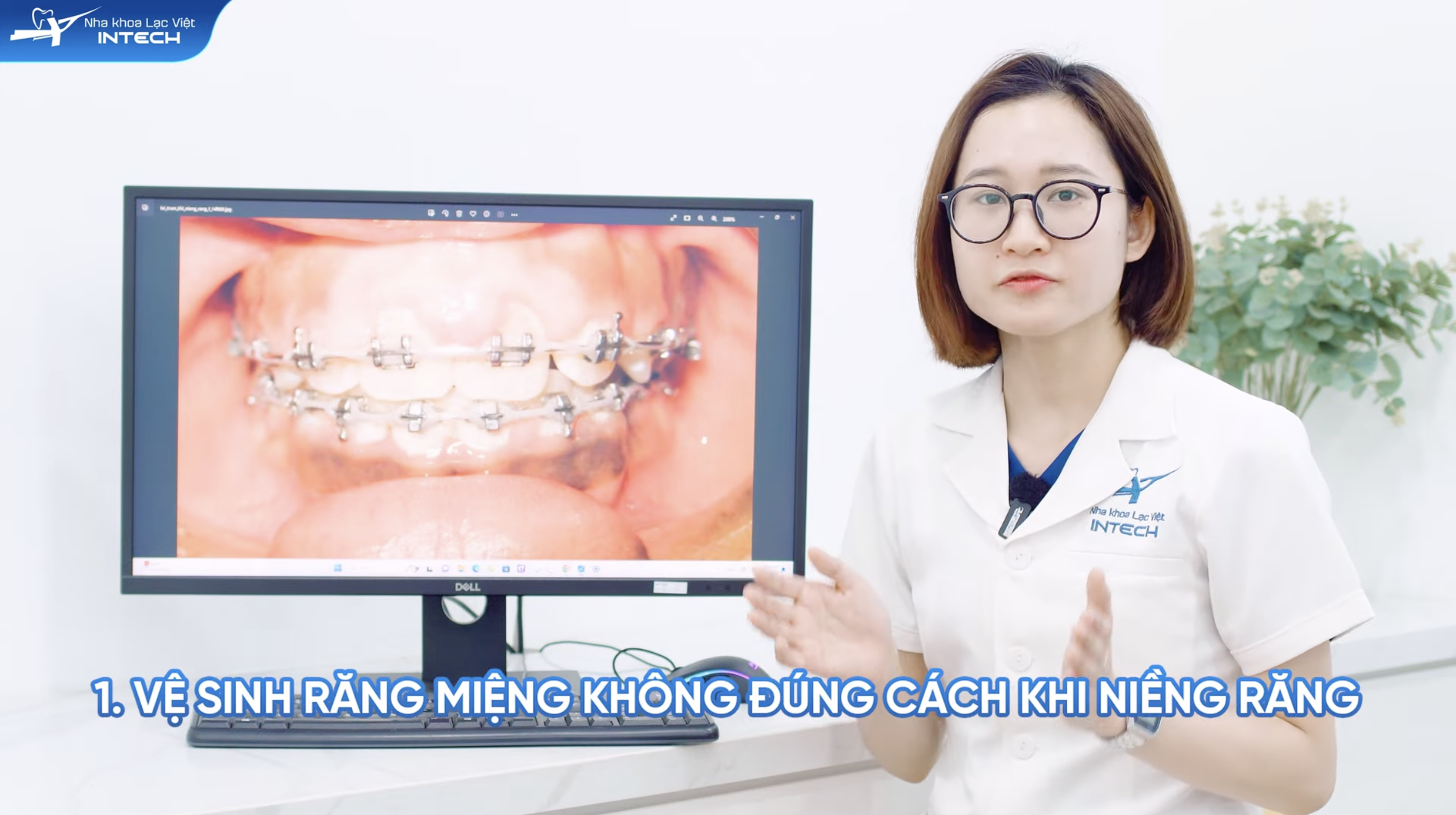 Không vệ sinh răng miệng đúng cách khi niềng răng là nguyên nhân hàng đầu gây viêm lợi khi niềng răng