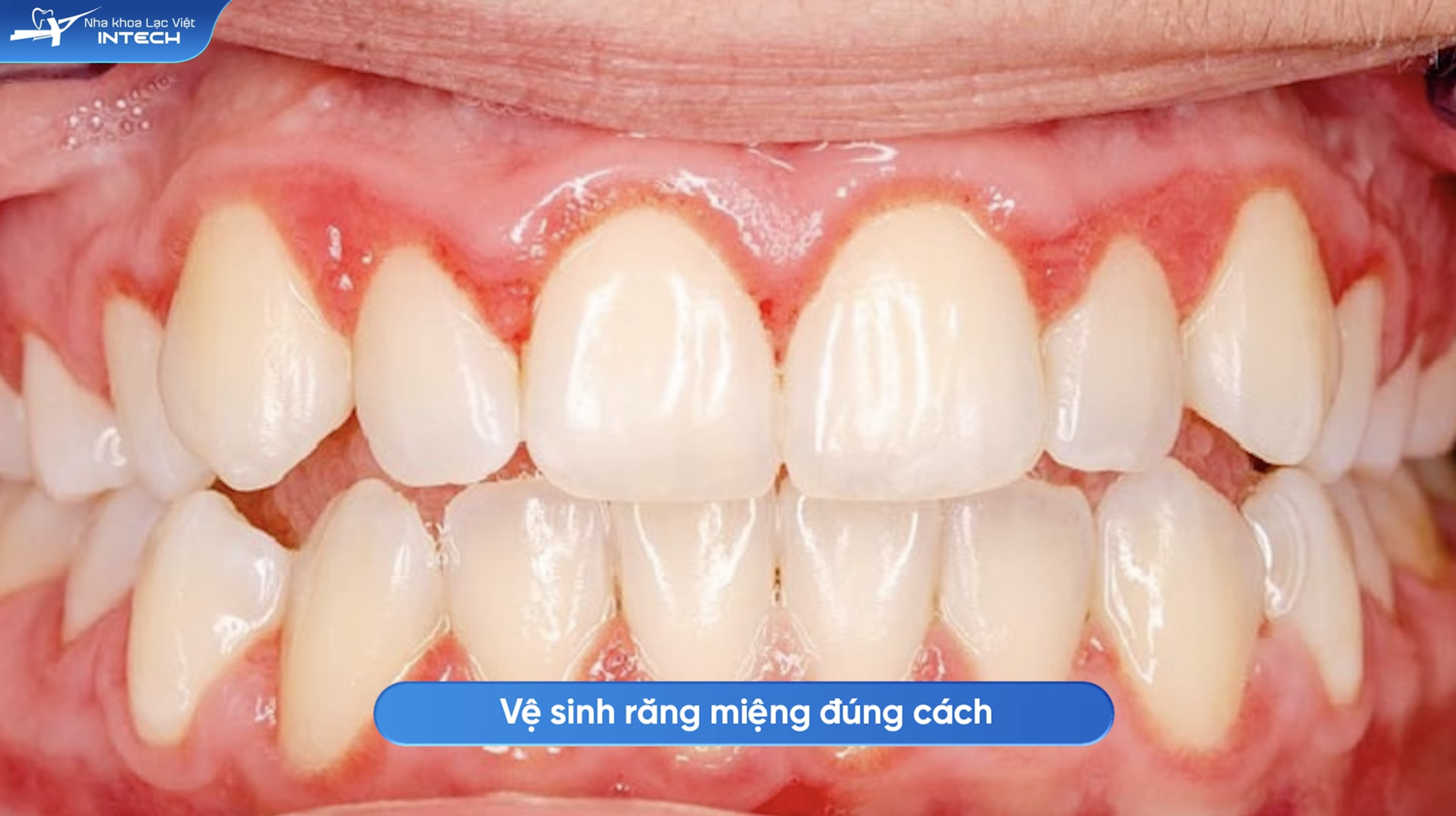 Vệ sinh răng miệng khoa học là yếu tố then chốt để tránh tái phát viêm lợi