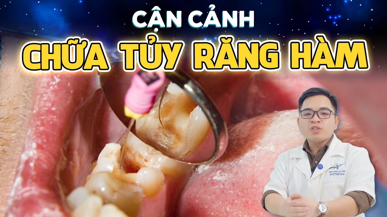 Quy trình điều trị tuỷ răng: Đọc kỹ trước khi làm kẻo hối hận