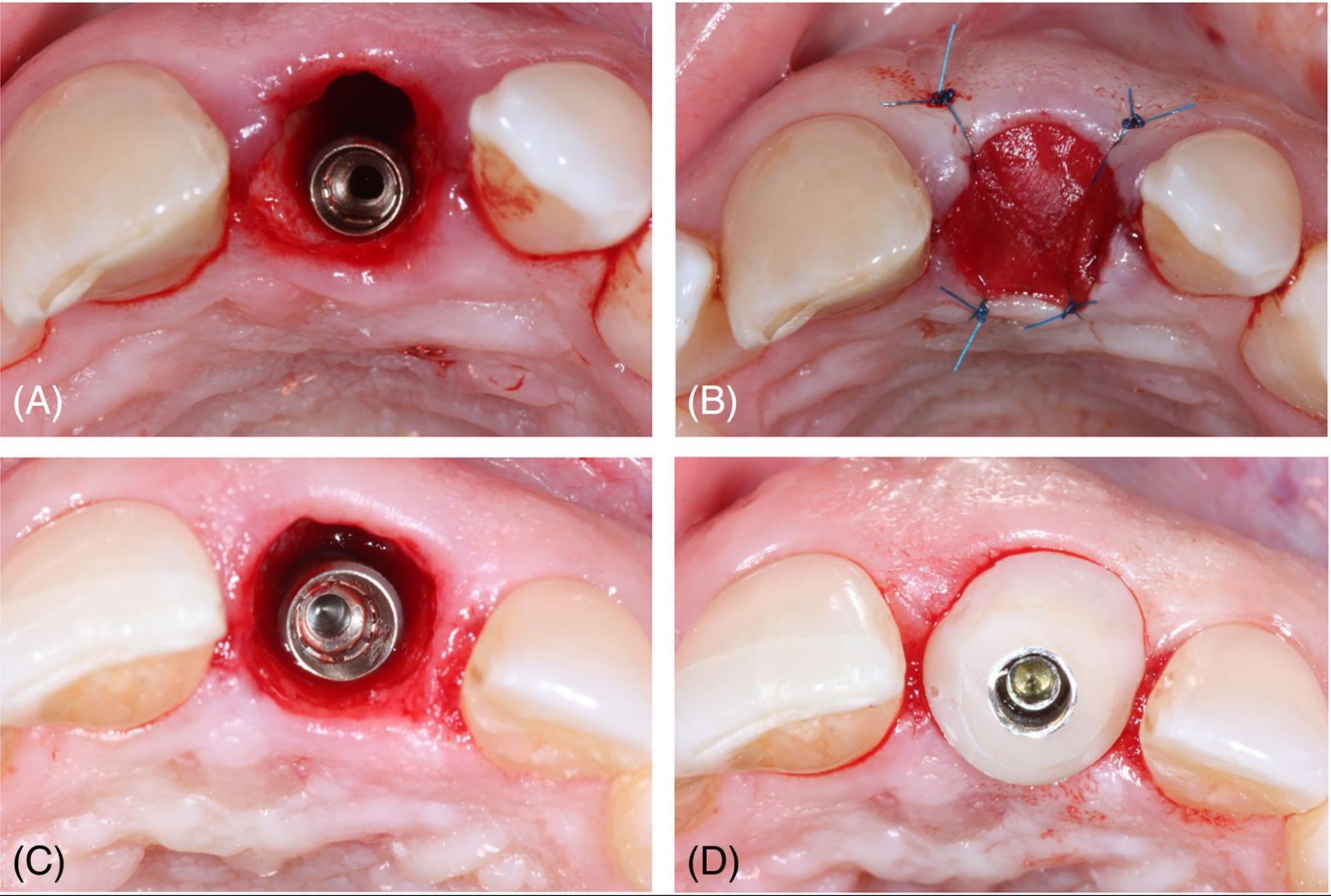 Chảy máu khi trồng răng Implant là hiện tượng bình thường, phụ thuộc vào nhiều yếu tố khác nhau