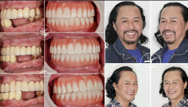 Các trường hợp bị viêm nha chu cũng có thể phục hình bằng cấy ghép Implant