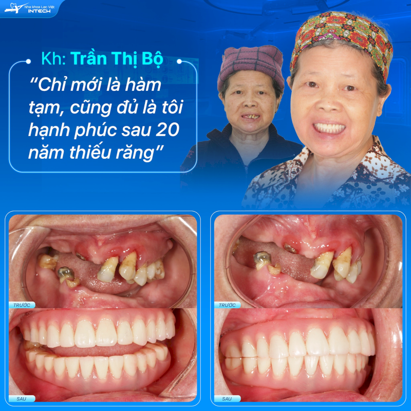 Cấy ghép Implant đáp ứng tốt các trường hợp mất răng lâu năm, đồng thời ngăn ngừa quá trình tiêu xương tiến triển