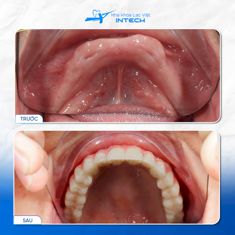 Người mất răng toàn hàm hoặc cả hai hàm vẫn có thể phục hình bằng phương pháp Implant All-On-4 hoặc All-On-6