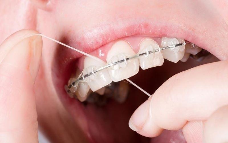 Chỉ nha khoa vệ sinh răng miệng khi niềng 