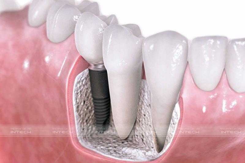 Chi phí trồng răng Implant khá cao so với các phương pháp phục hình răng khác