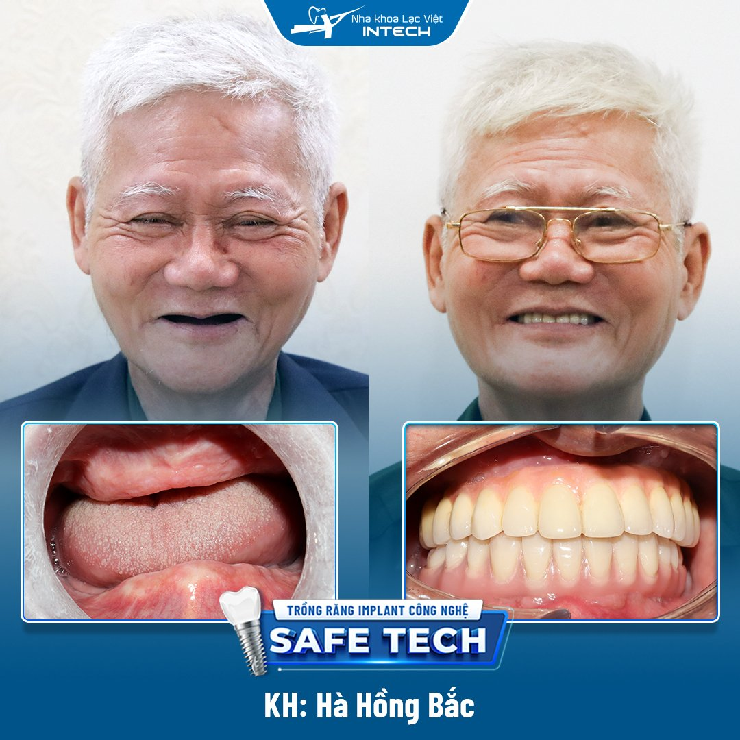 Chú Hà Hồng Bắc thực hiện trồng răng Implant All On 4 toàn 2 hàm tại Lạc Việt Intech