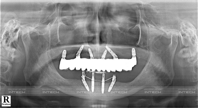 Hình ảnh phim chụp X-quang sau cấy ghép Implant của chú Bình