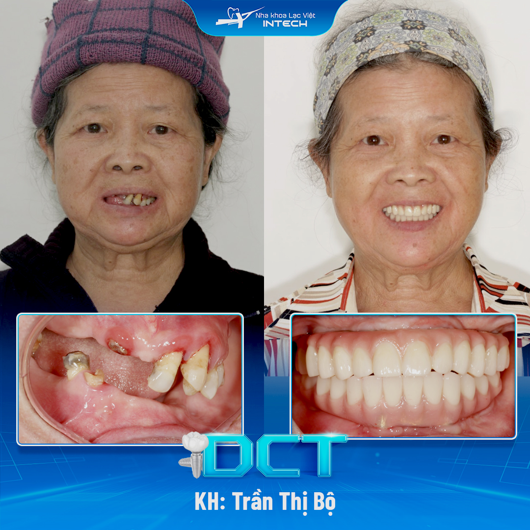 trồng implant