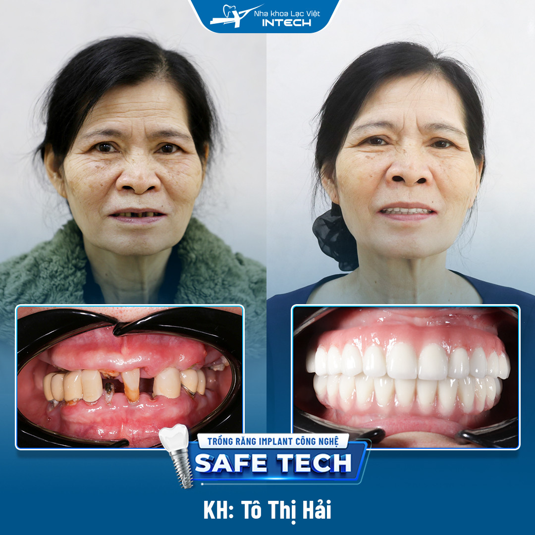 Cô Tô Thị Hải - Khách hàng trồng răng Implant bởi bác sĩ Hưng