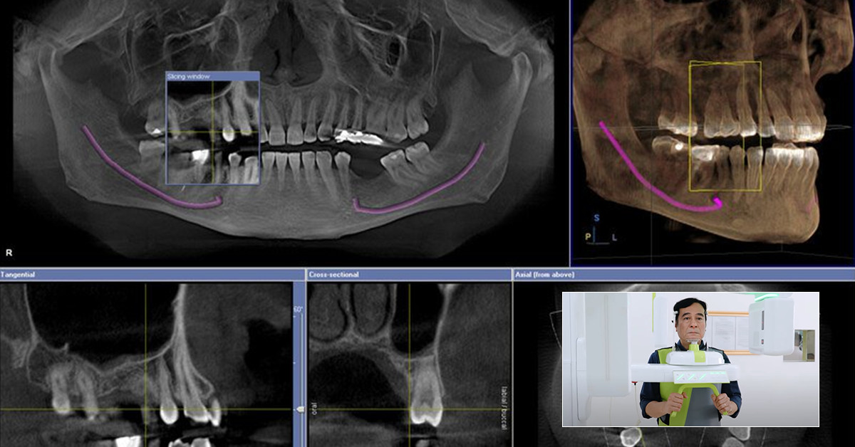 Công nghệ trồng răng implant Safe Tech 