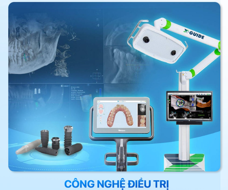 Trồng răng Implant ở đâu tốt TPHCM - Nha khoa Lạc Việt Intech là câu trả lời với công nghệ hiện đại