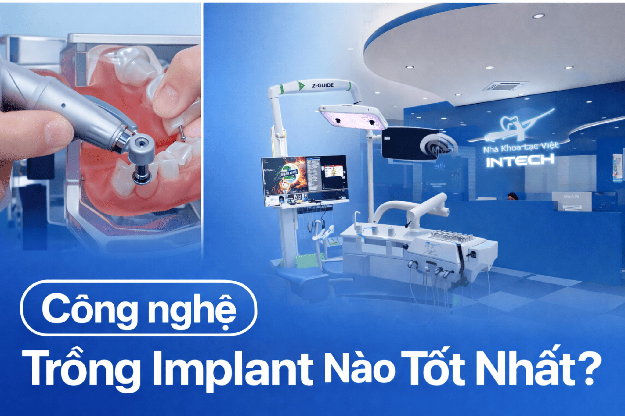 Những Công Nghệ Trồng Răng Tốt Nhất Hiện Nay: Tại Sao Lại Tăng Độ Chính Xác và An Toàn Hơn?