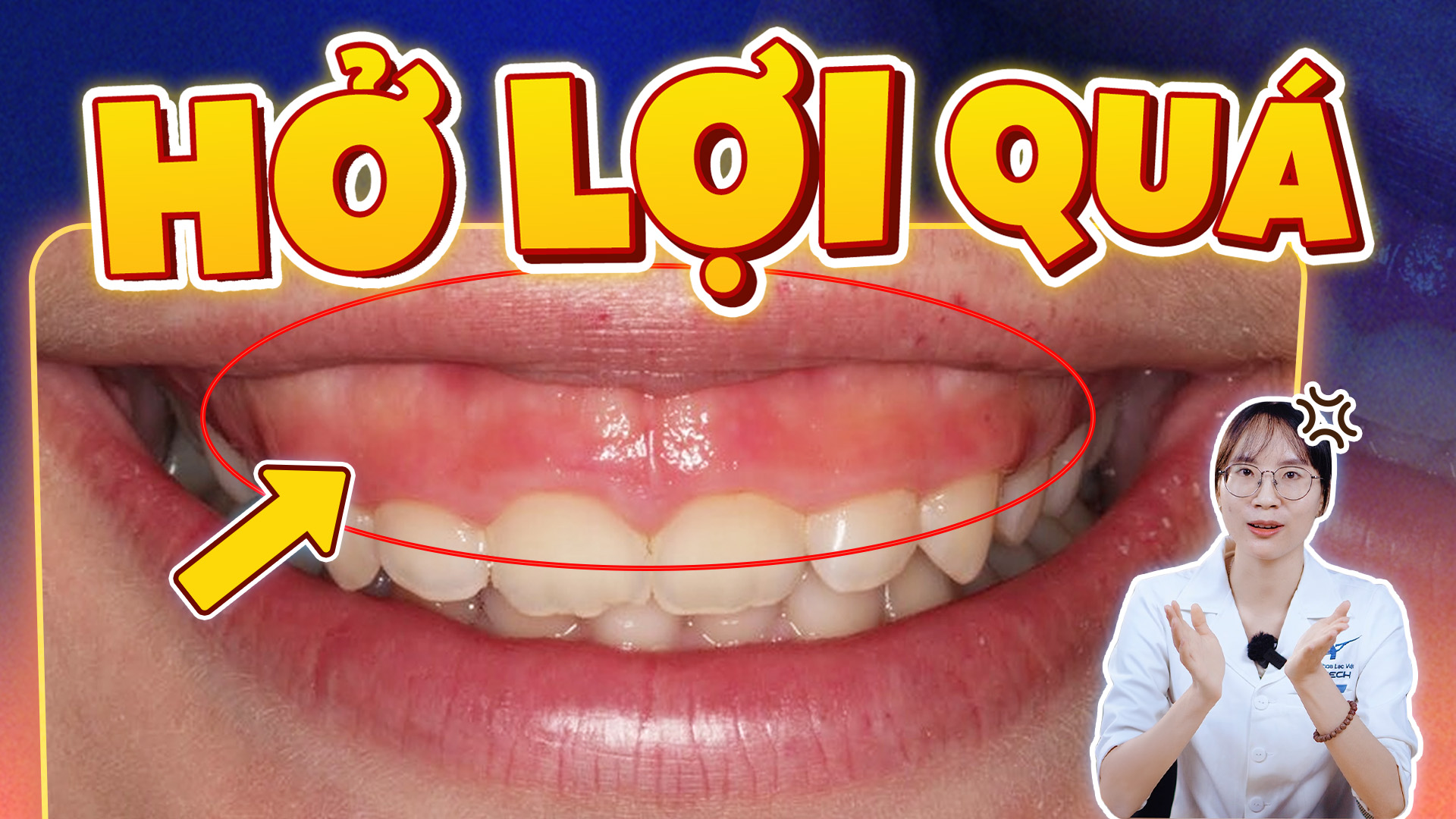 Nụ cười hở lợi: 5 cách điều trị hiệu quả, an toàn và bền vững