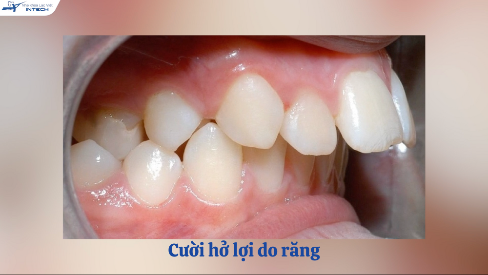 Cười hở lợi do răng