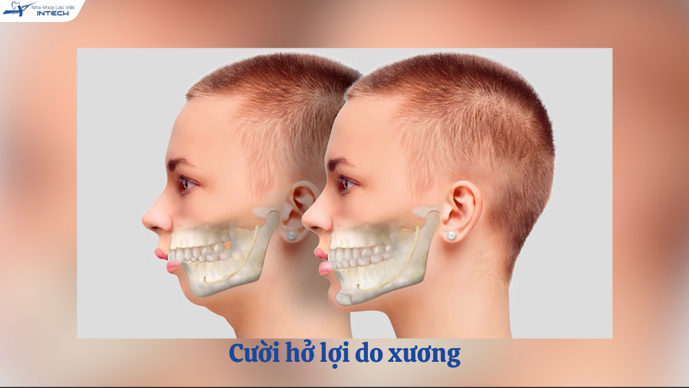 Cười hở lợi do xương