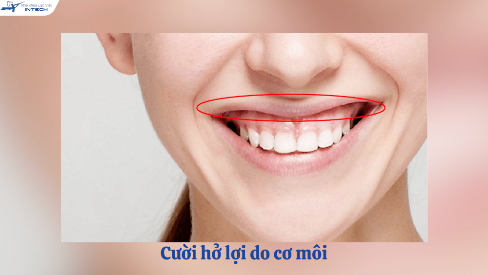 Cười hở lợi do cơ môi