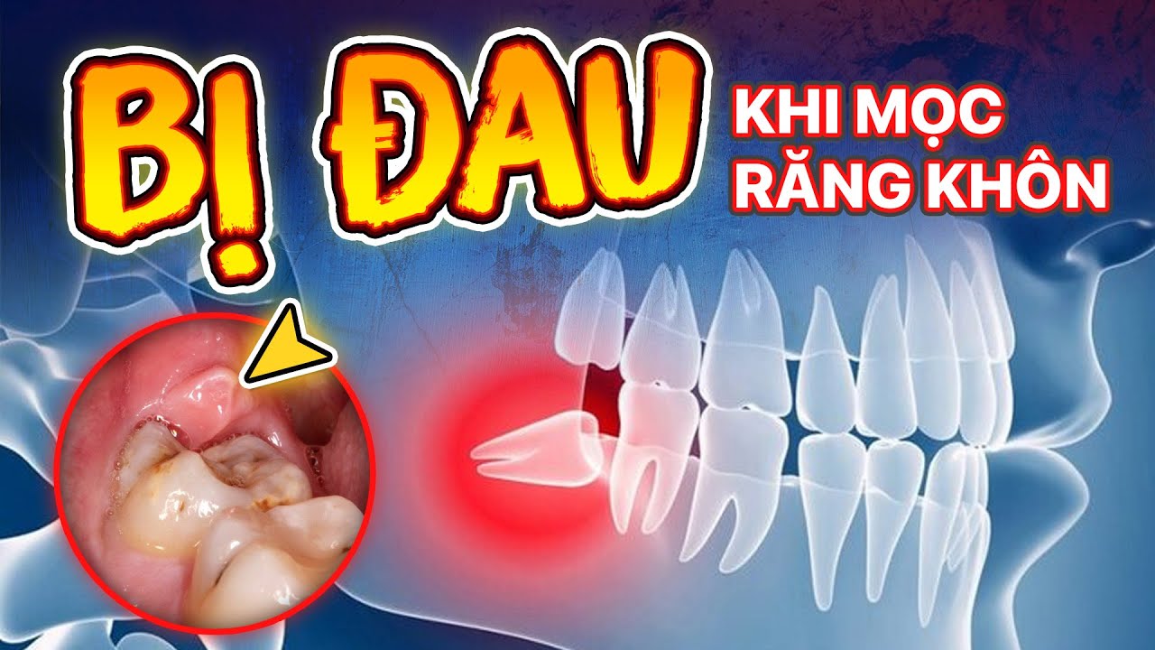 Mọc răng khôn: Các dấu hiệu và phương pháp giảm đau tại nhà 