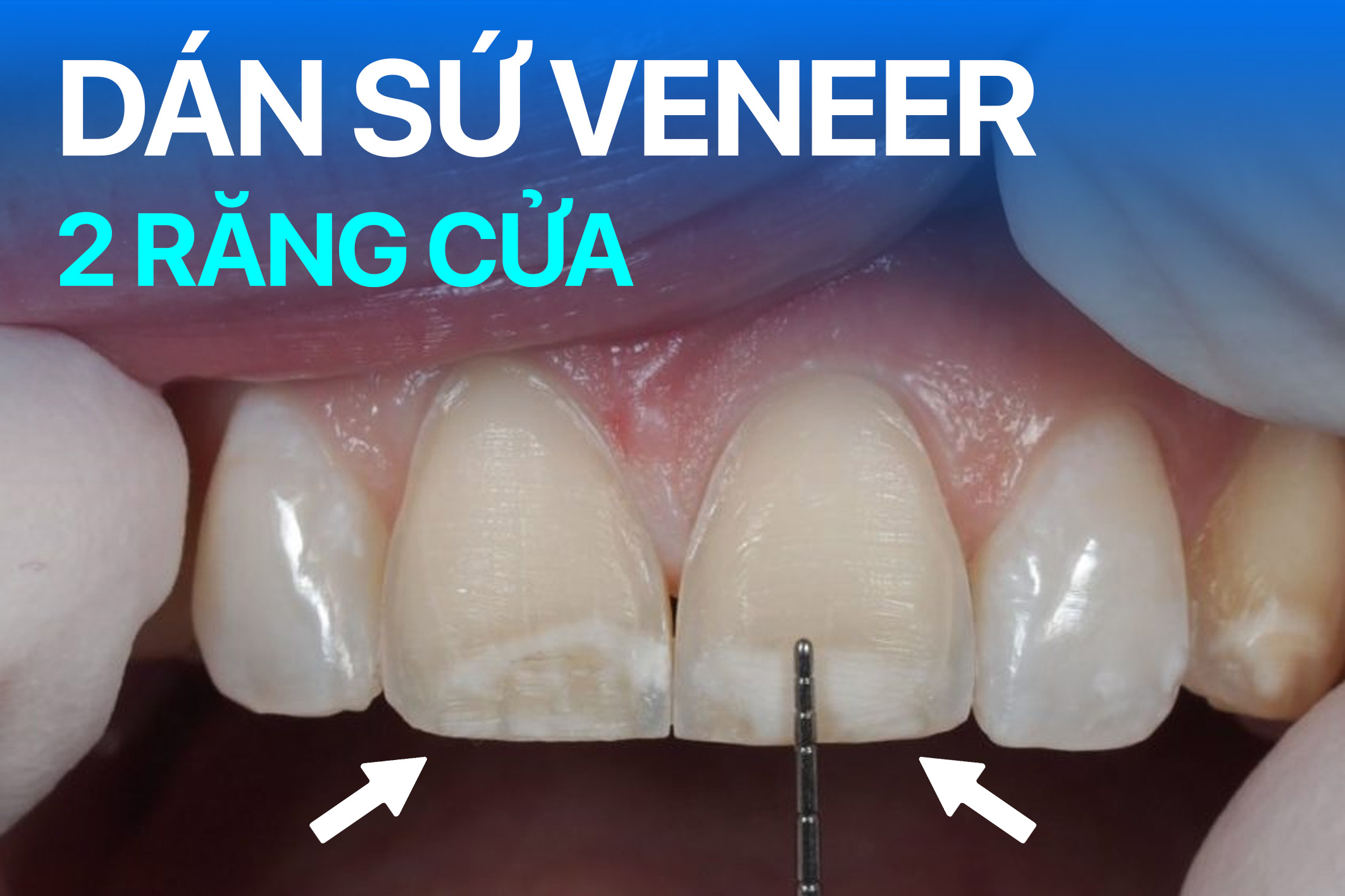 Dán sứ veneer 2 răng cửa giá bao nhiêu? Nên chọn loại mặt dán sứ nào?