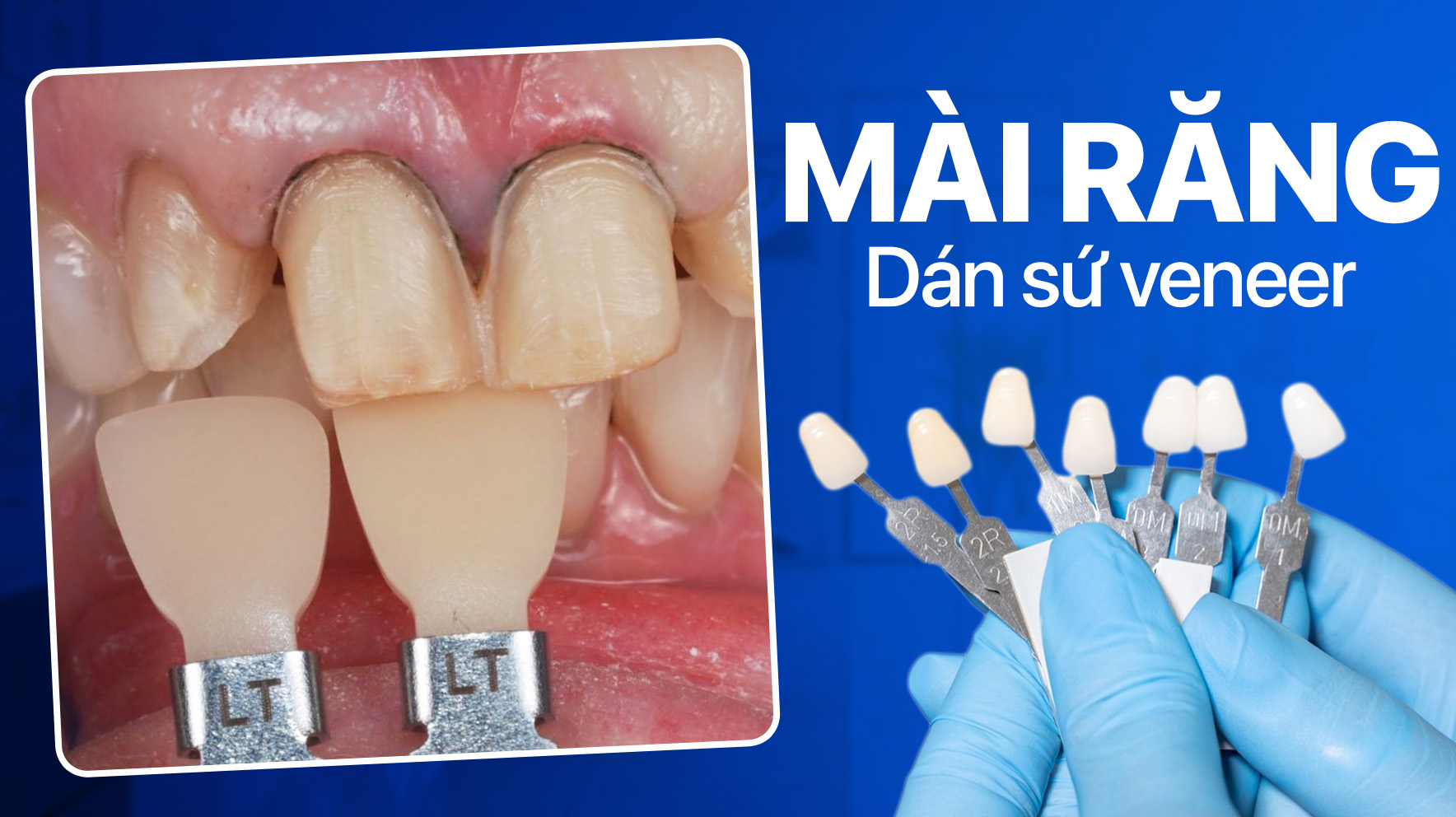 Dán sứ veneer có mài răng không? Bóc trần sự thật về dán sứ không mài! 