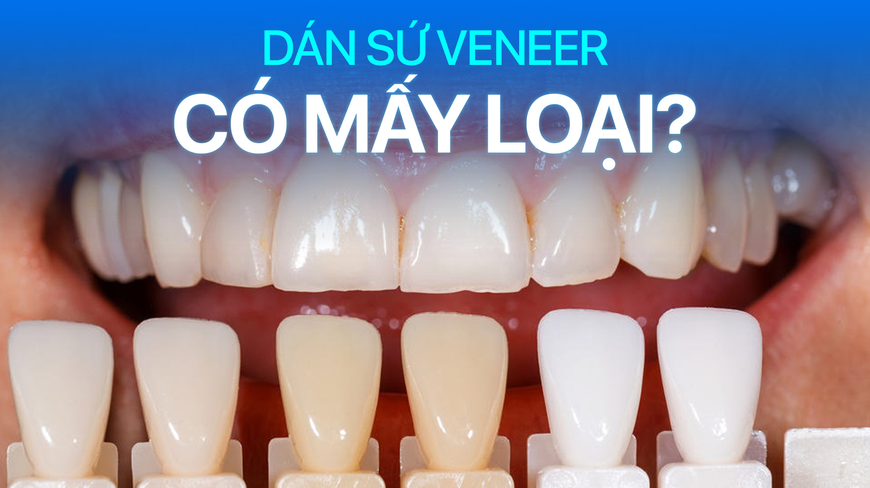 Dán sứ veneer có mấy loại? Loại nào tốt nhất? Loại nào rẻ nhất mà vẫn đảm bảo chất lượng?