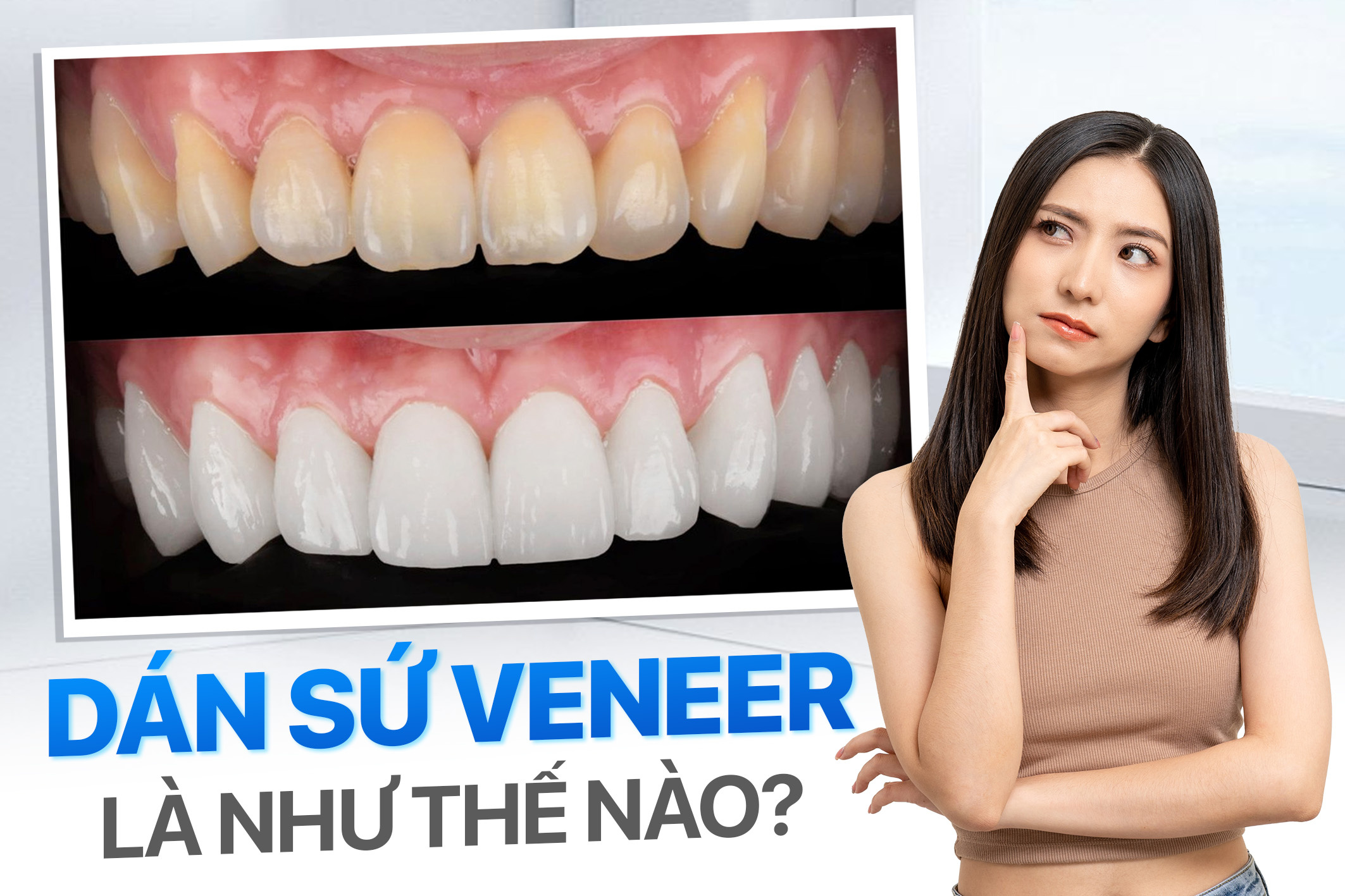 Dán sứ veneer là như thế nào? Khám phá quy trình dán sứ 7 bước chuẩn y khoa 