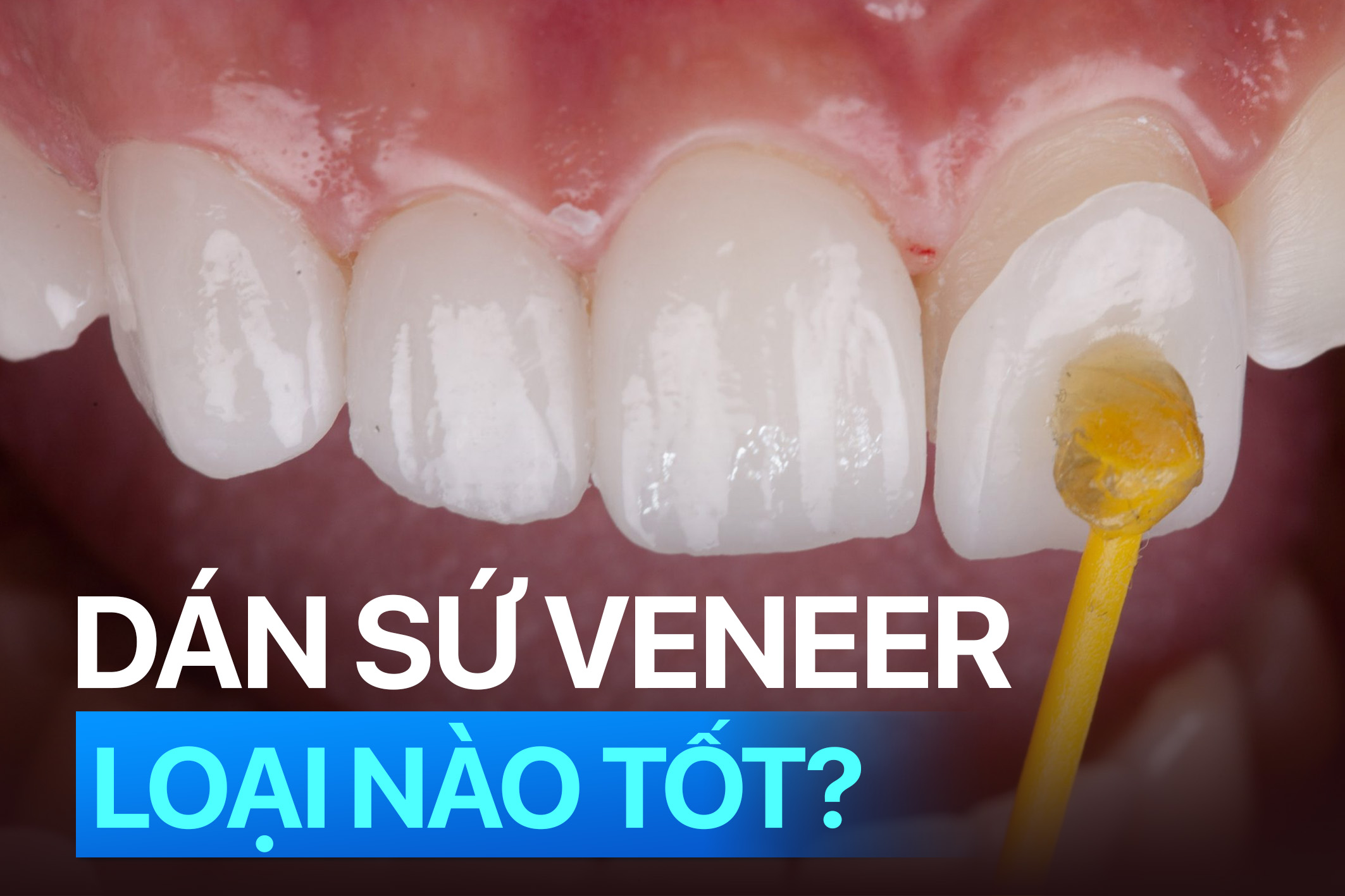 Dán sứ veneer loại nào tốt nhất? Giá bao nhiêu 1 răng?